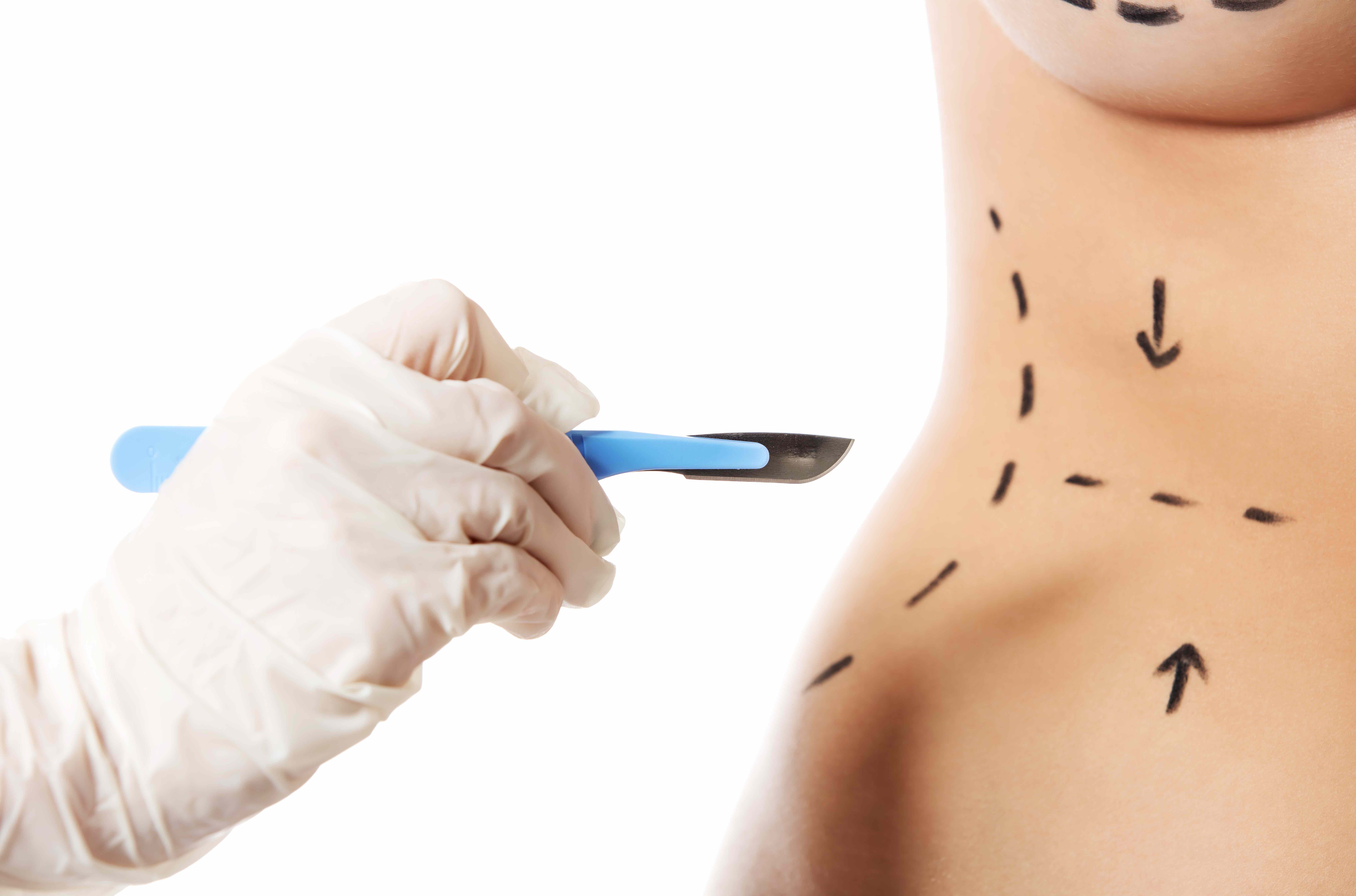Cosmetic surgery 
